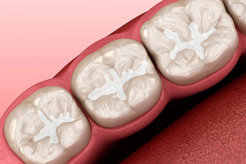 Dental Sealants in San Antonio